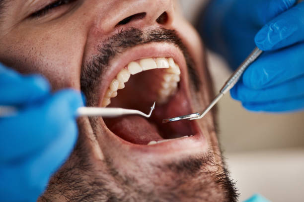 Best Emergency Wisdom Teeth Removal in Sallisaw, OK